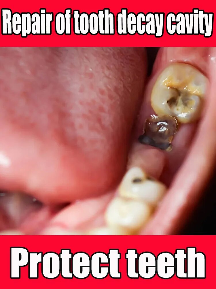 Reparación de caries. Repare todas las caries y proteja los dientes. Eliminación de manchas de placa. Blanqueamiento dental para reparación de caries