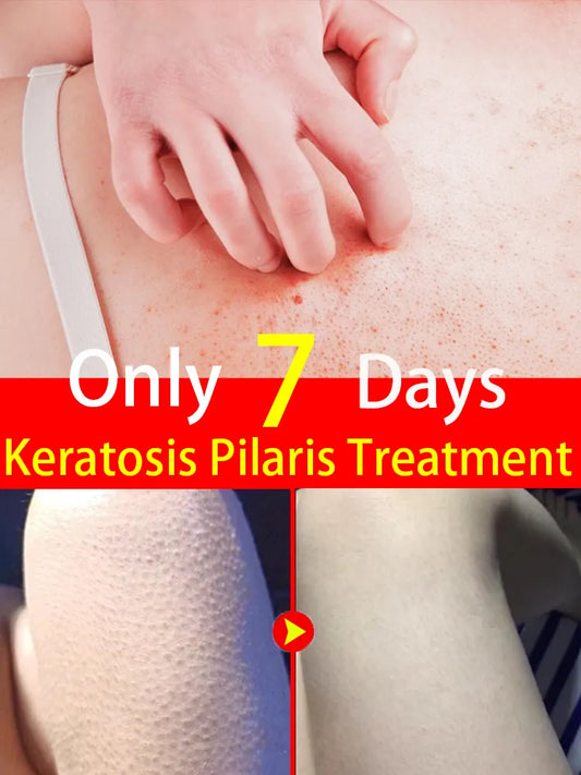 Keratosis Pilaris Cream  Rough Goosebumps Tiny Bumps Small Red Bumpy Chicken Skin Removal