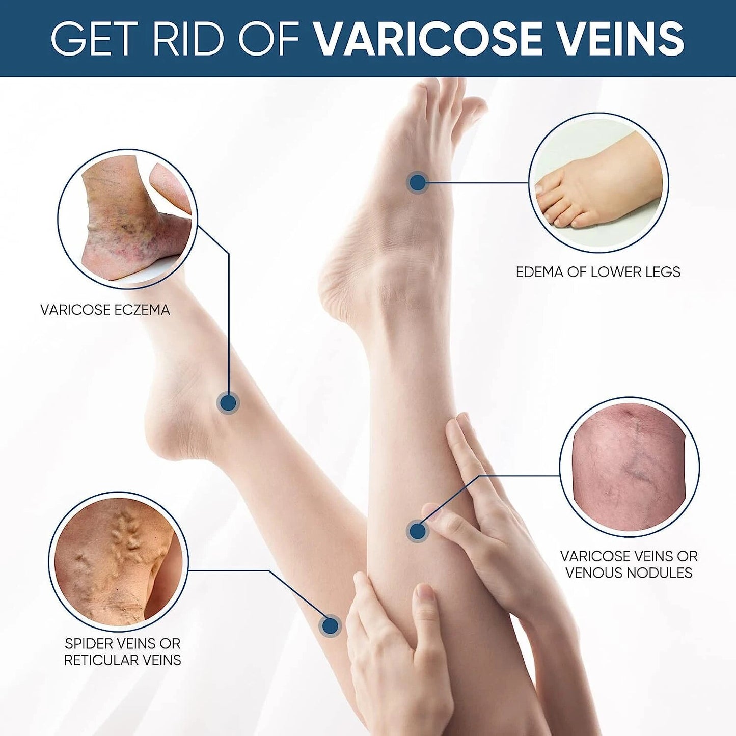 Effective Varicose Vein Relief Cream Ointment For Varicose Veins To Relieve Vasculitis And  Phlebitis Treatment.