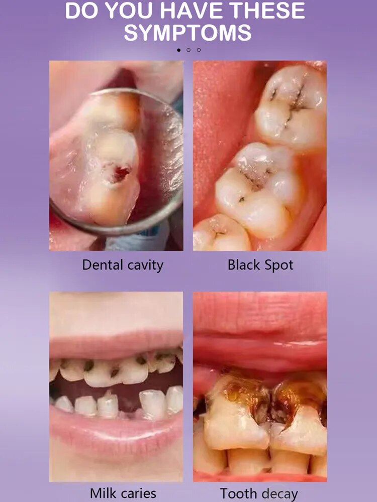 Reparación de caries. Repare todas las caries y proteja los dientes. Eliminación de manchas de placa. Blanqueamiento dental para reparación de caries